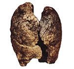 喫煙者の肺